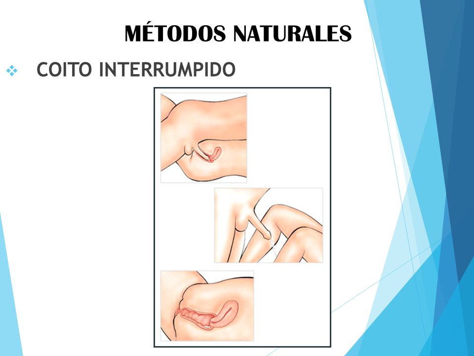 Desventajas del coito interrumpido metvc
